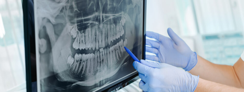 Osteomyelitis and Dental Malpractice